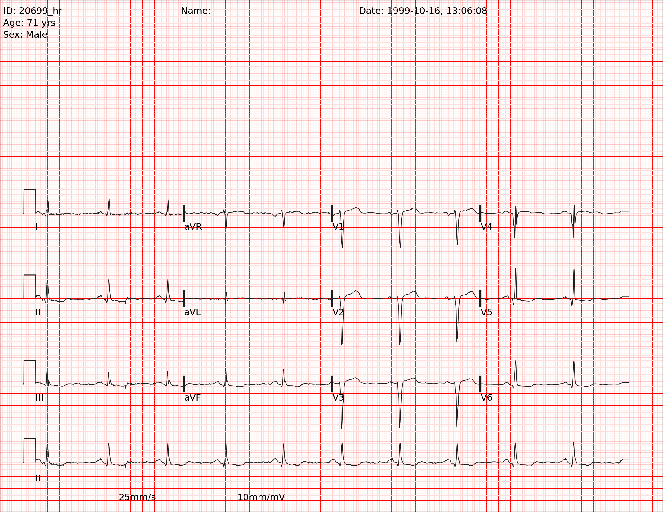ECG ejemplo limpio 2
