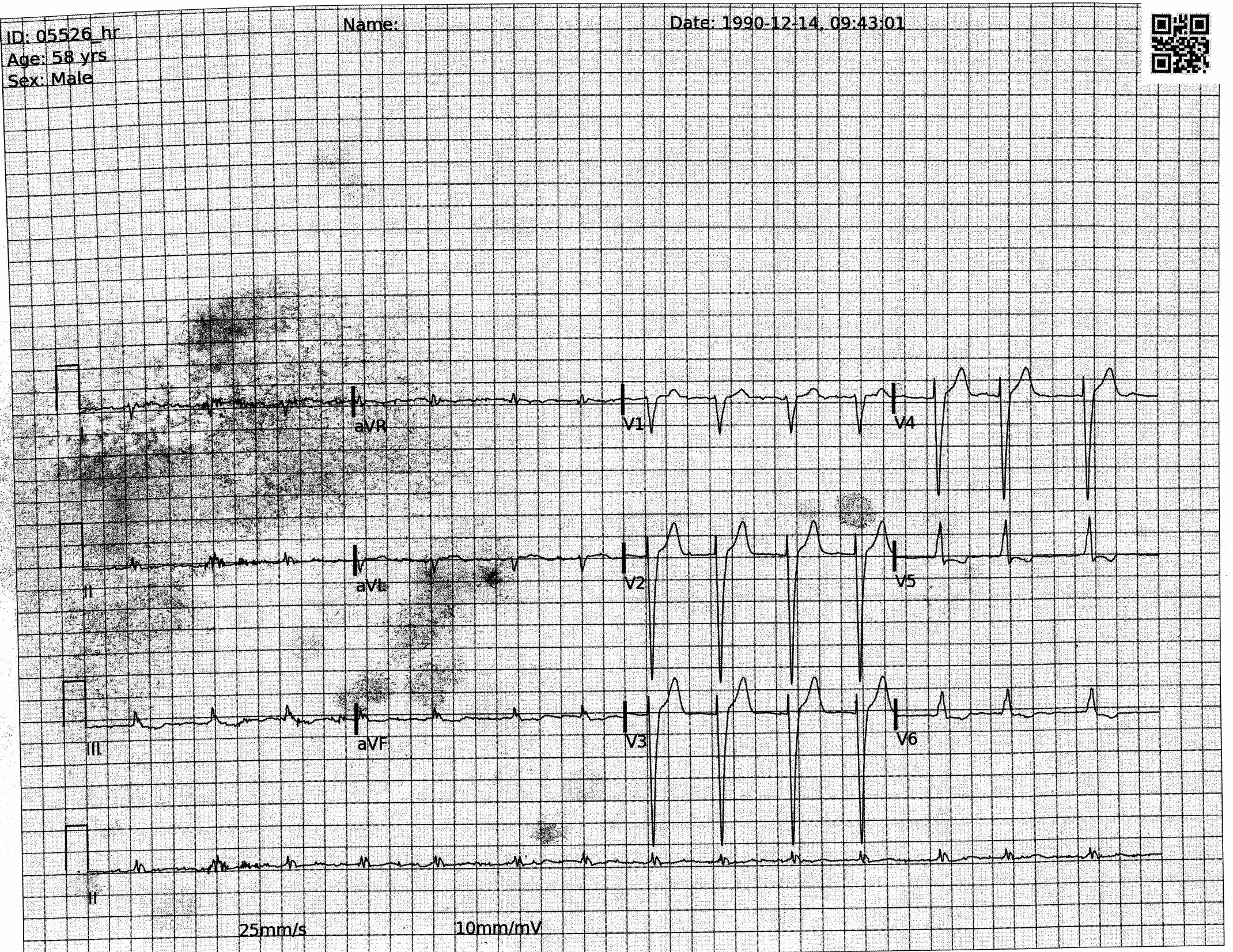 ECG con cuadrícula marcada