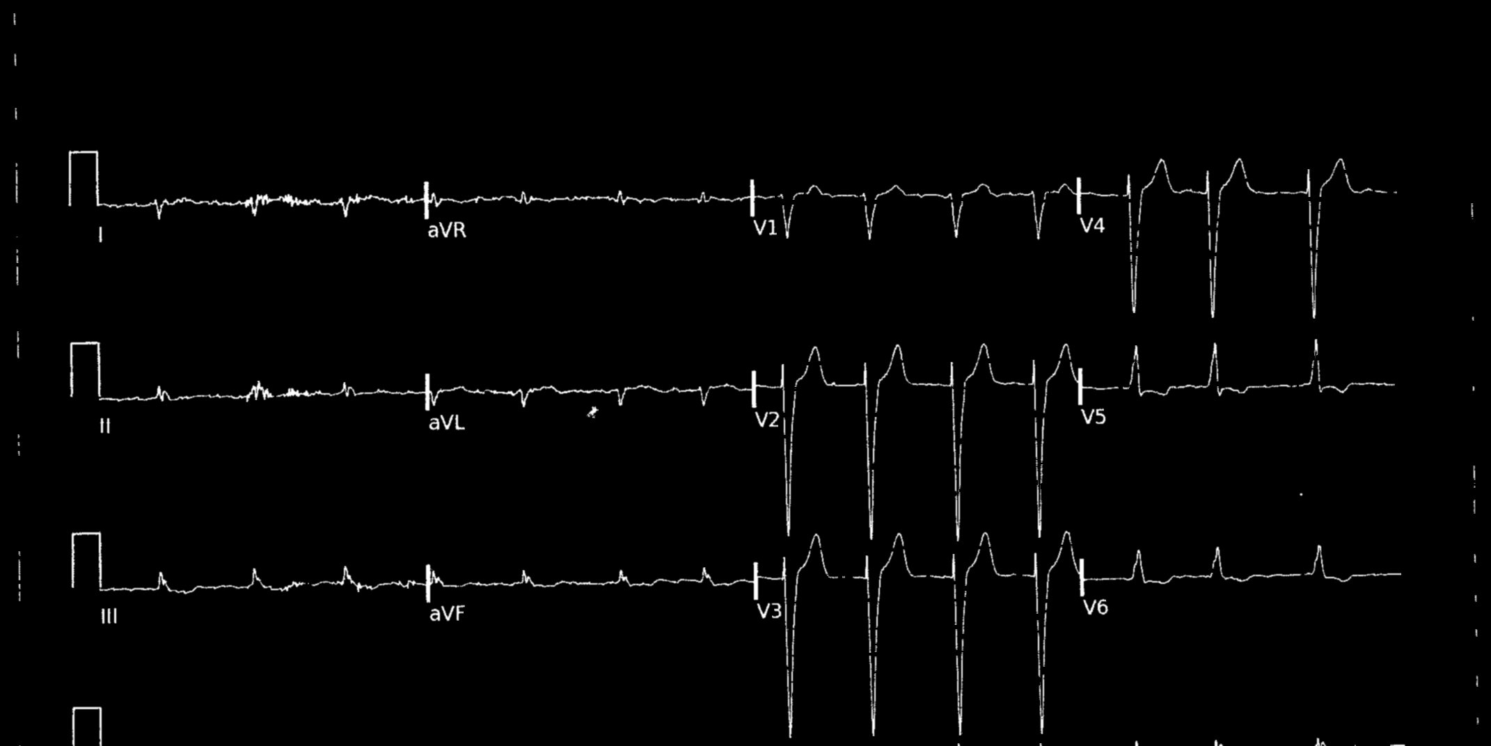 ECG limpio sin cuadrícula